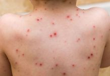 U Istočnom Sarajevu šest, u Palama jedno oboljelo od morbila