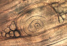 Primljena dva pacijenta sa kliničkom slikom trihineloze