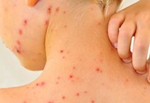 Vakcinacija – najefikasniji način sprečavanja morbila i drugih zaraznih bolesti