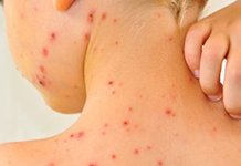 Морбилима заражено 311 лица, највише у Бијељини